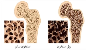 تصویر از از هر سه زن، یک نفر و از هر پنج مرد  یک نفر دچار شکستگی ناشی از پوکی استخوان می شود